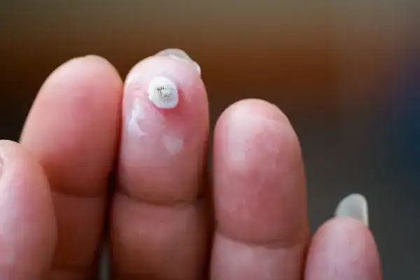 Image of white wart before cryopen treatment Salisbury