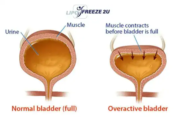 diagram of overactive bladder treatment Salisbury