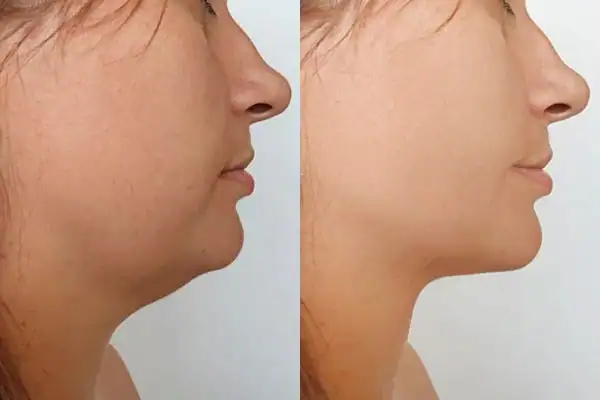 Fat dissolving injections results Salisbury