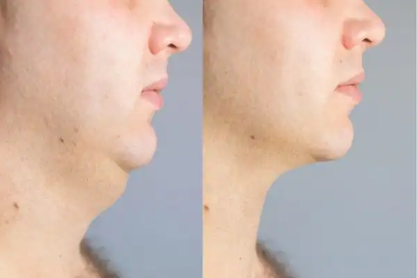 Fat dissolving injections results Salisbury