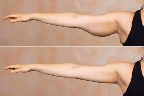Results on the arms of fat dissolving injections Salisbury