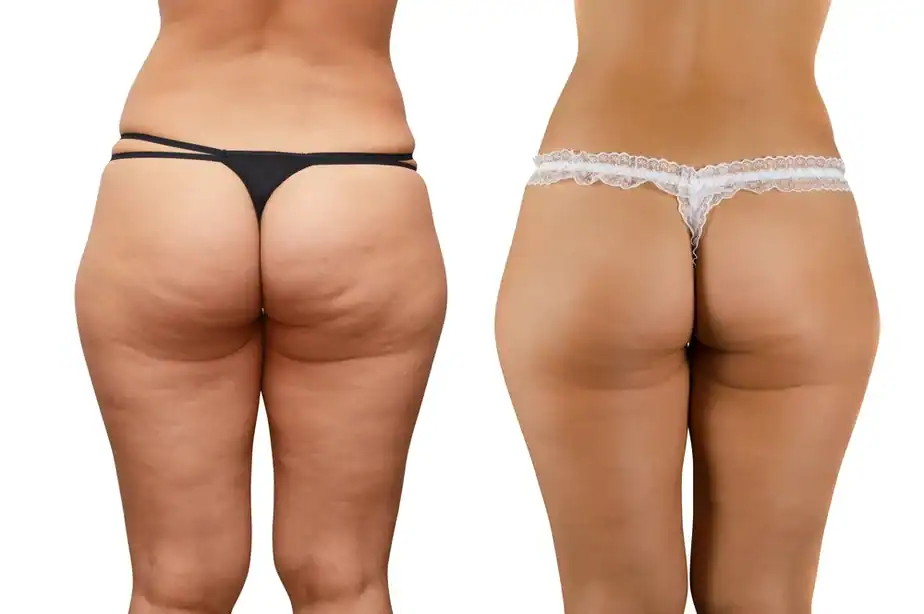 Before and after cellulite treatment Salisbury results.