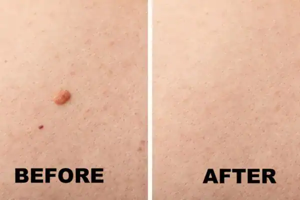 mole removal results before and after Cryopen Cryotherapy Treatment Salisbury