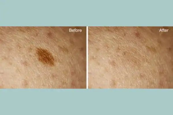 Before and after age spot removal following Cryopen Cryotherapy Treatment Salisbury