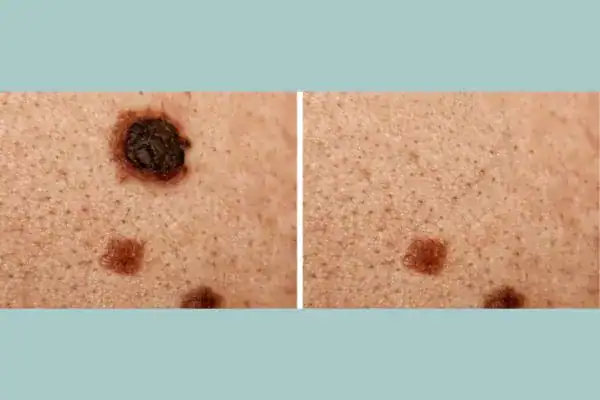 Before and after results from Cryopen Cryotherapy Treatment Salisbury