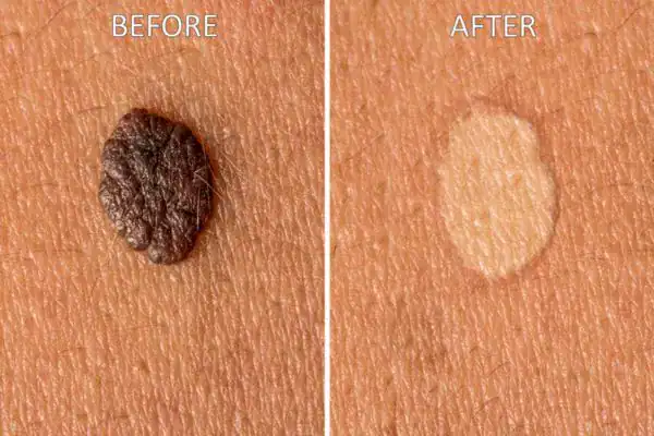 Wart removal results before and after Cryopen Cryotherapy Treatment Salisbury