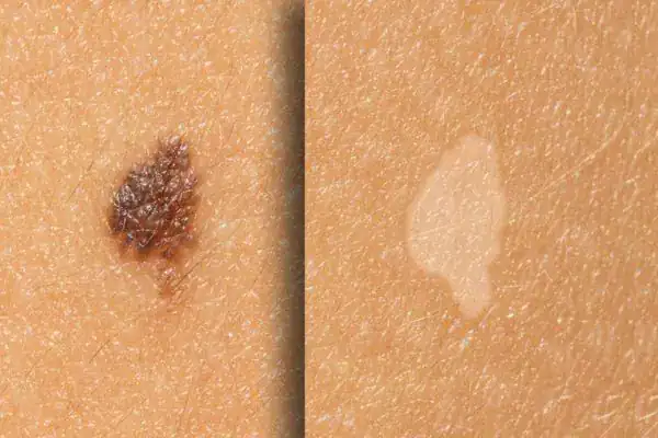 Before and after results Cryopen Cryotherapy Treatment Salisbury