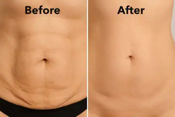 before and after body toning treatment Salisbury