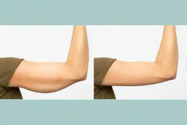 Before and after results of arm toning treatment Salisbury