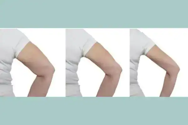 before and after results of arm toning treatment Salisbury