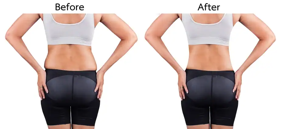 Before & After back toning treatment Salisbury