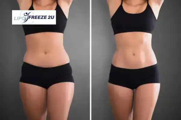 before and after results of body toning treatment Salisbury