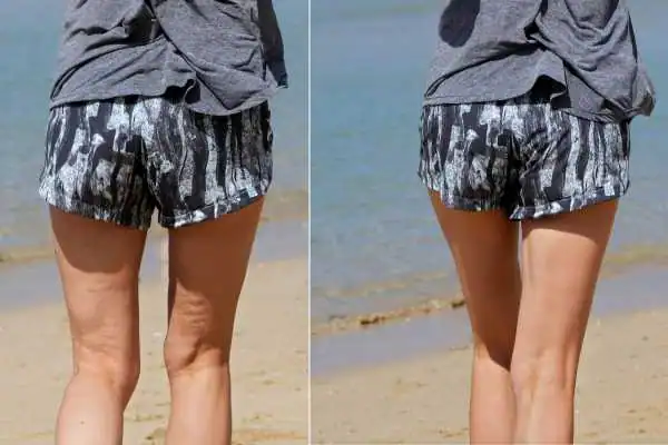 before and after results of cellulite treatment Salisbury