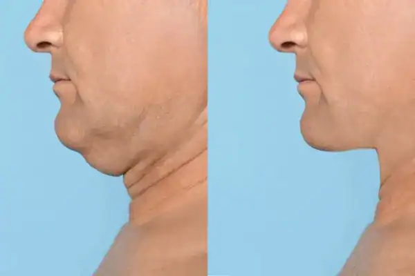 mans before and after chin toning treatment Salisbury results.