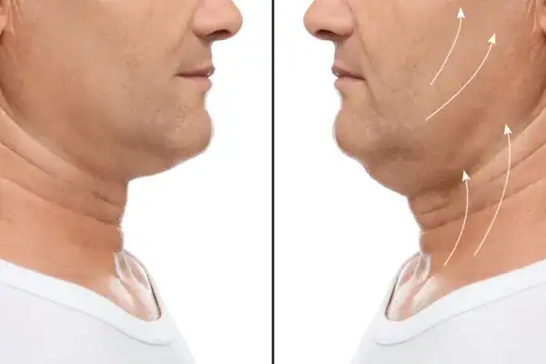 Before and after chin toning treatment Salisbury results.