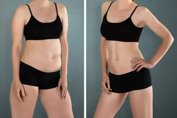 Before and after hip toning treatment Salisbury