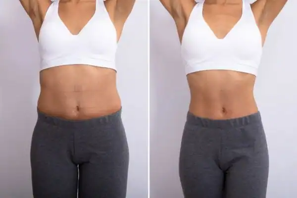 Before and after results of Hip toning treatment Salisbury