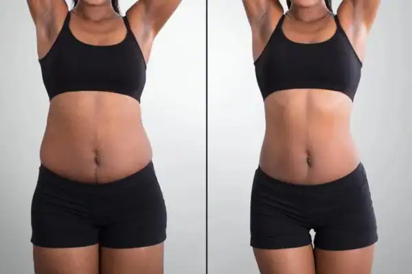 before and after hip toning treatment Salisbury