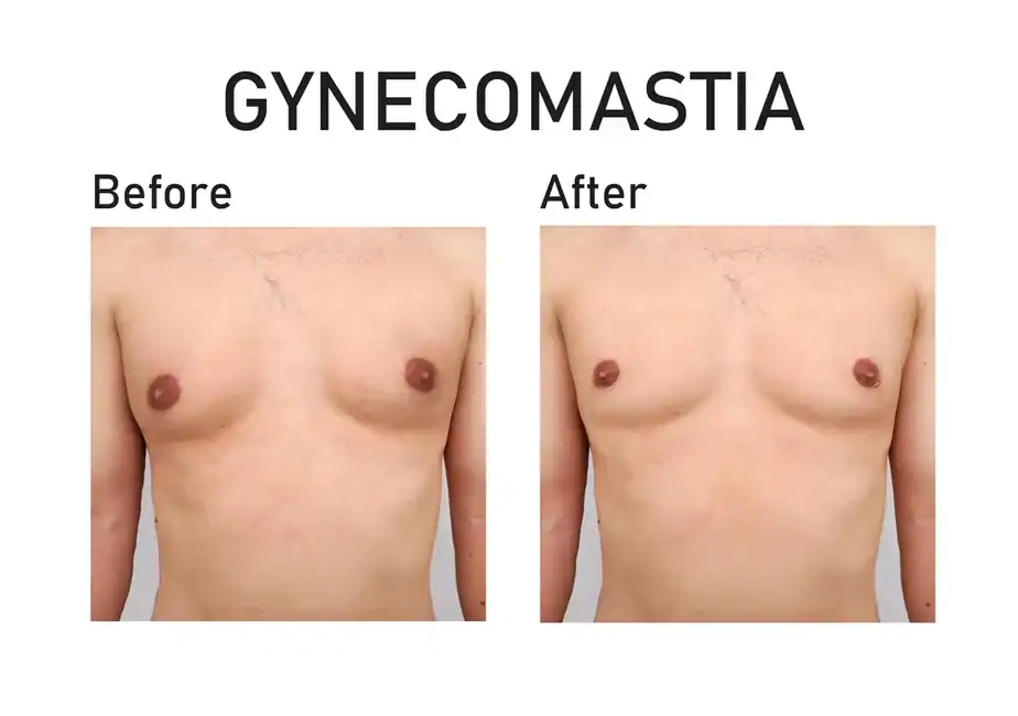 before and after man boobs treatment Salisbury