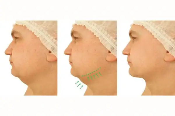neck toning treatment 1