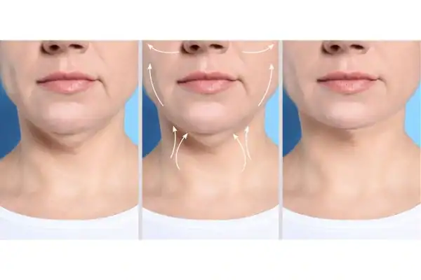 womans result of neck toning treatment Salisbury