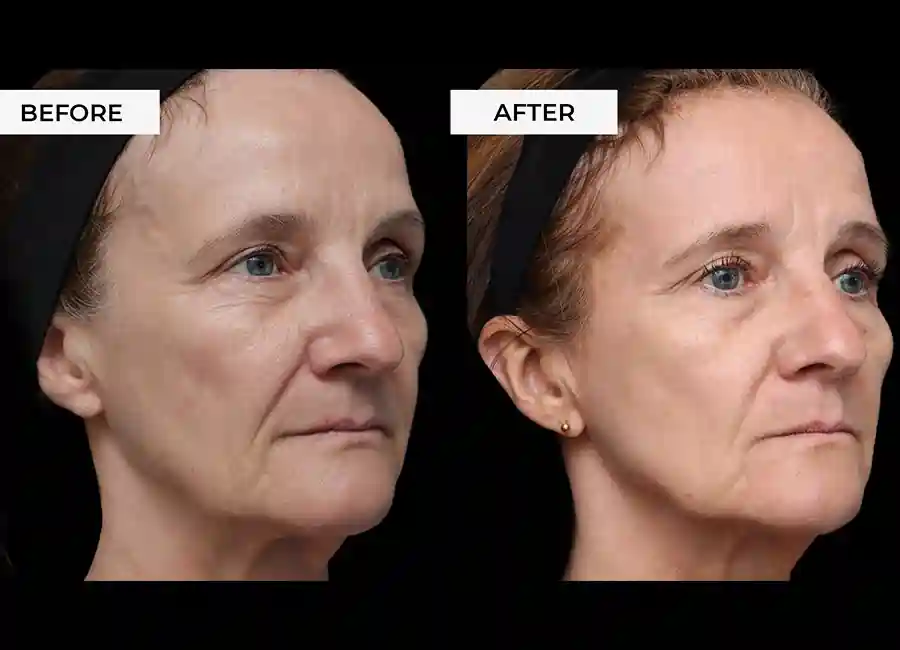 How Many RF Microneedling Sessions Will You Need to See a Difference Salisbury?
