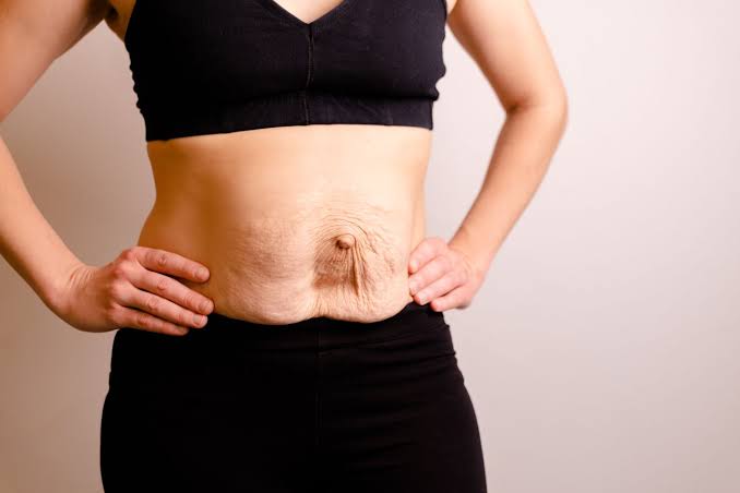 Is Surgery Really the Only Way to Repair Diastasis Recti Salisbury?