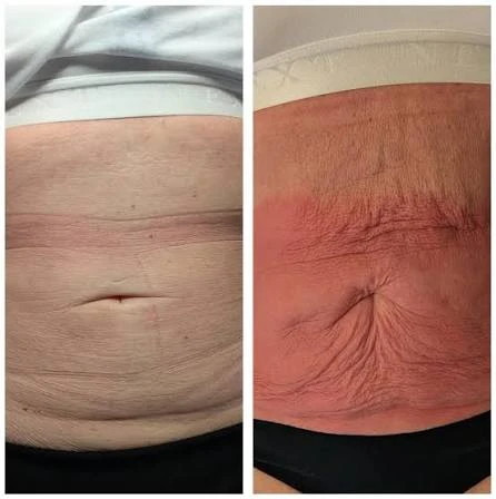 How Does RF Microneedling Improve Crepey, Thin and Uneven Skin Texture Salisbury?