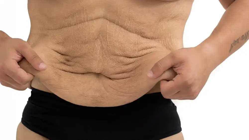 RF Microneedling for Loose Skin: How Can It Help Tighten and Reshape the Skin Salisbury?